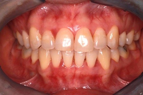 invisalign1after