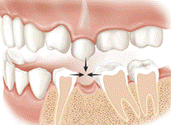 teeth drifting after loss of tooth