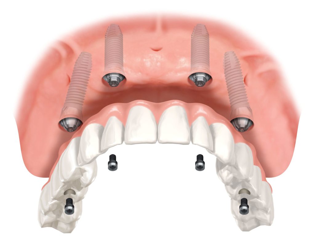 fixed denture implant