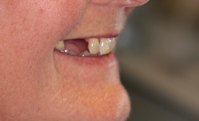 Before dental implants in Ely, Cambridgeshire